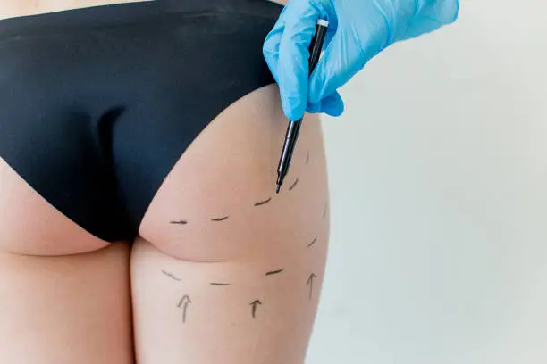 Gluteoplastia híbrida resultados